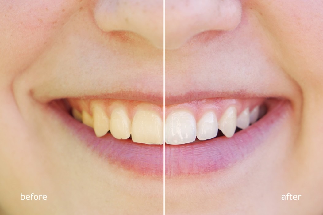 Professional Dental Cleaning